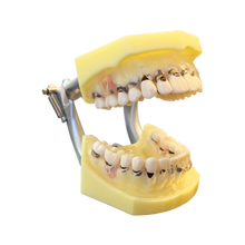 Load image into Gallery viewer, Model boală parodontală cu dinţi detaşabili cu şurub - 4028