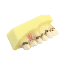 Load image into Gallery viewer, Model boală parodontală cu dinţi detaşabili cu şurub - 4028