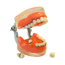 Load image into Gallery viewer, Model boală parodontală cu dinţi detaşabili pe cadranul 4 - 4017